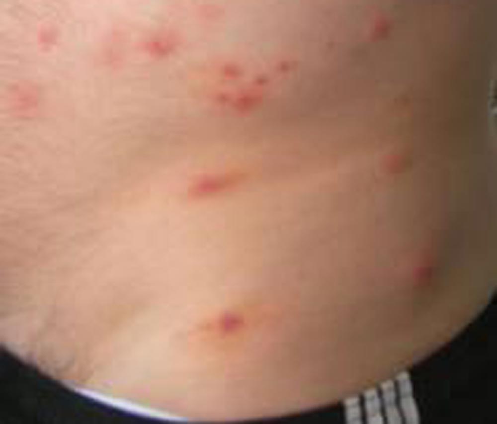 Un nuovo “tarlo” estivo per la pelle svago Come eliminare il tarlo dai mobili