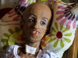 progeria