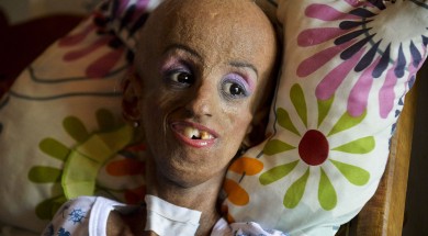 progeria