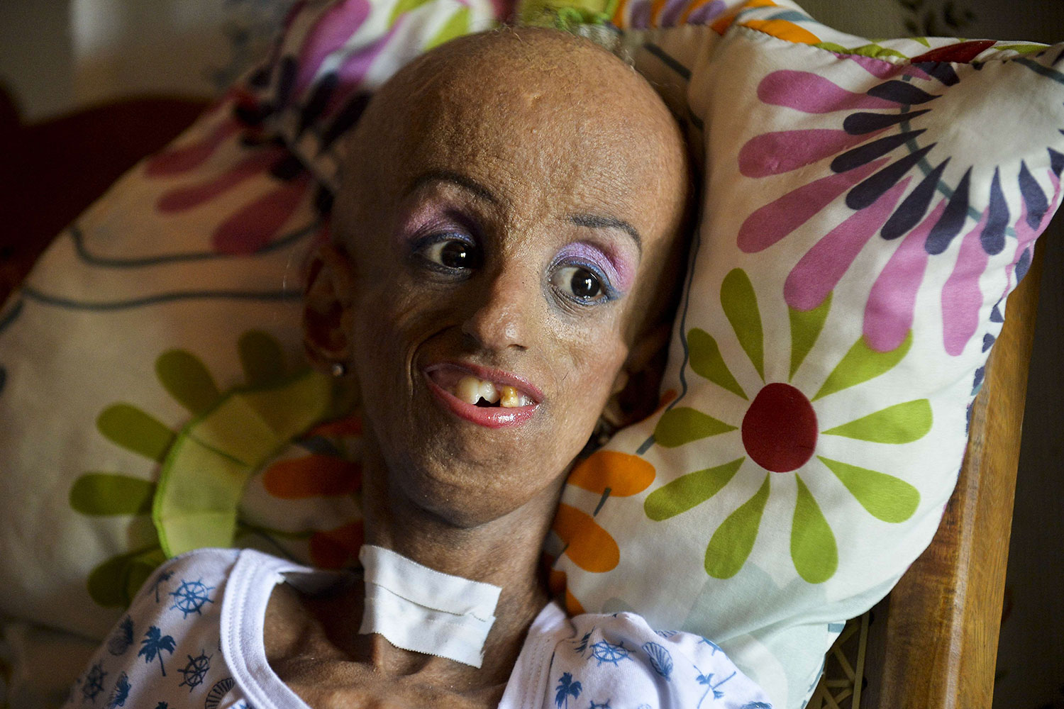 Magali e la progeria: la storia della bambina con la sindrome dei nati vecchi