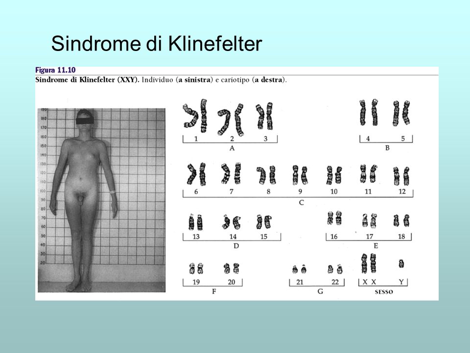La sindrome di Klinefelter