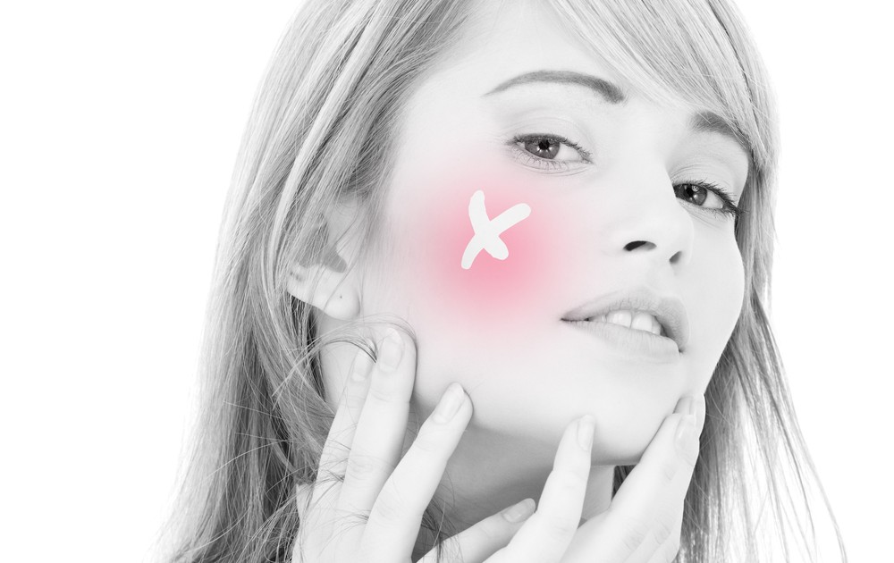 Rosacea: sintomi, cause e come curarla