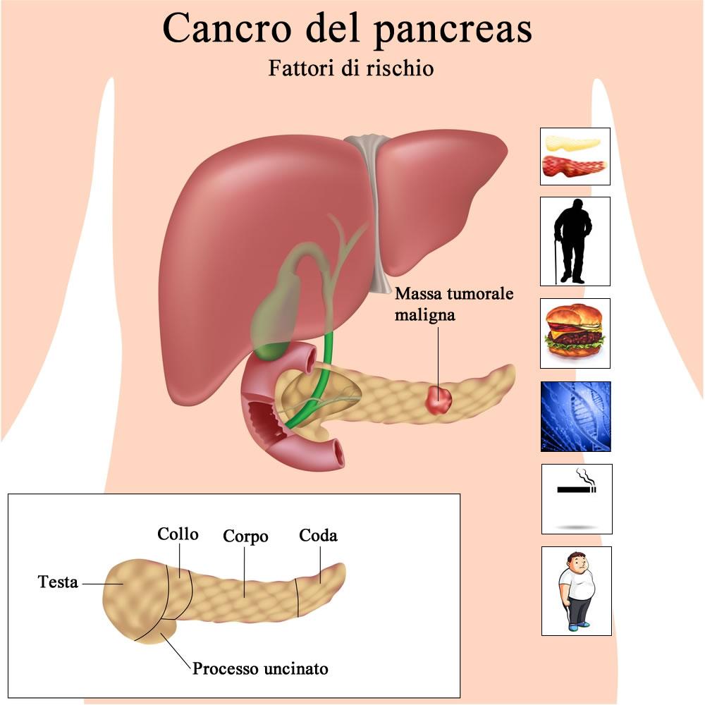 Tumore pancreas, Aiom: va curato solo in centri di riferimento, così possiamo garantire migliore assistenza