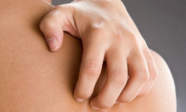 Orticaria: rimedi naturali per curarla